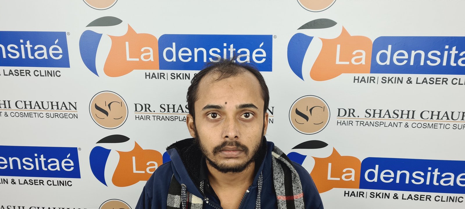 Ashis Yadav Before Hair Transplant